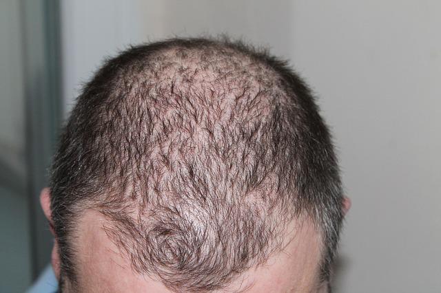 hair-loss-nyc-dr-roya