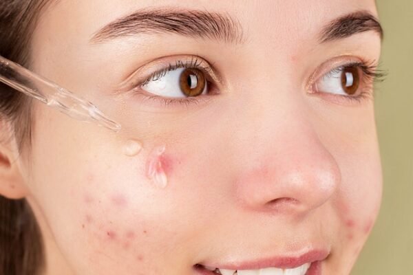 acne-scars-scarring-nyc-dr-roya