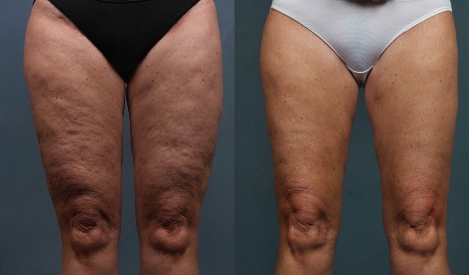 Cellulite Reduction Treatment Doctor Roya New York City