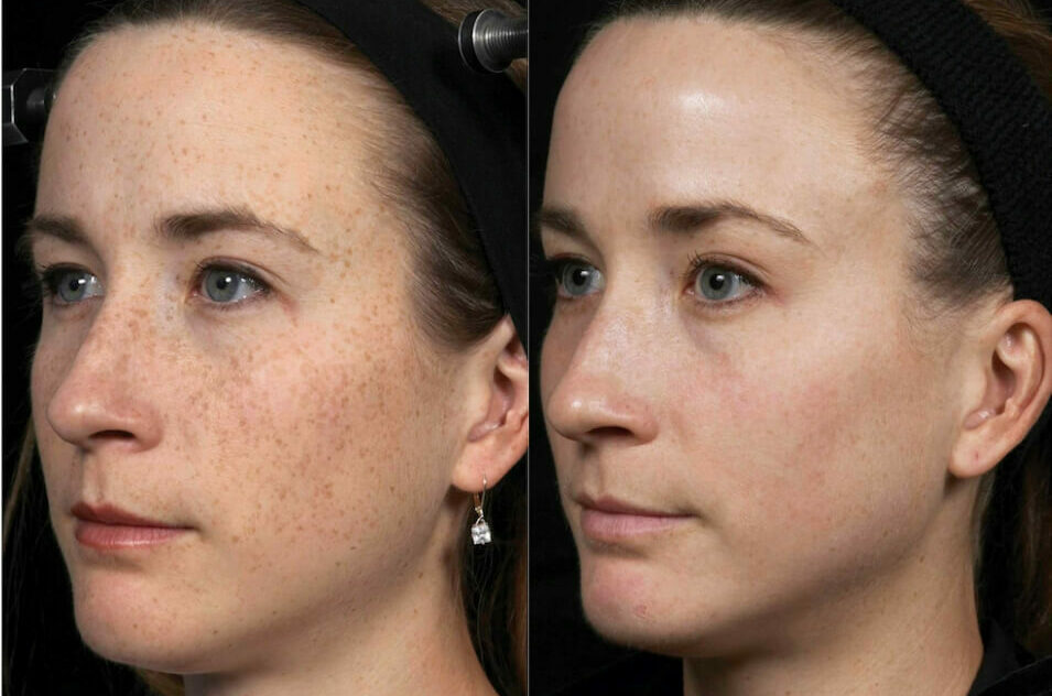 fraxel-laser-before-and-after-doctor-roya