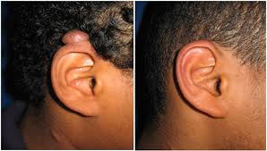 keloid-scar-removal-dr-roya